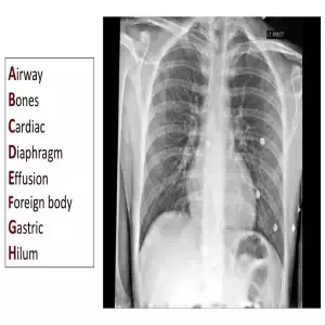 CXR ABC